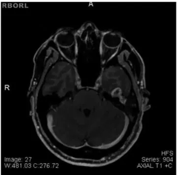 Figura 1  Ressonância magnética em corte axial em T1 com  contraste mostrando formação expansiva localizada próxima  ao gânglio geniculado e porção timpânica do nervo facial à  es-querda.