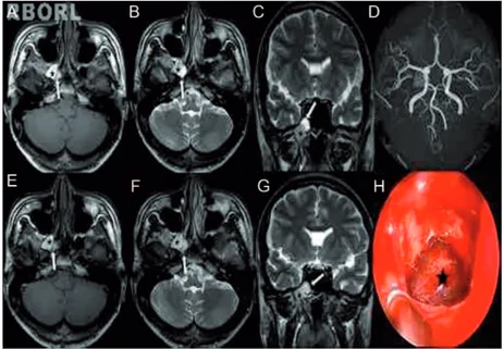 Figura 1  A-D, A mucocele é composta por duas partes separadas. A RM ponderada em T1 (A, axial) mostra uma parte hiperintensa  (estrela negra: alto conteúdo proteico) e uma parte levemente hiperintensa (seta branca: alto conteúdo de água)