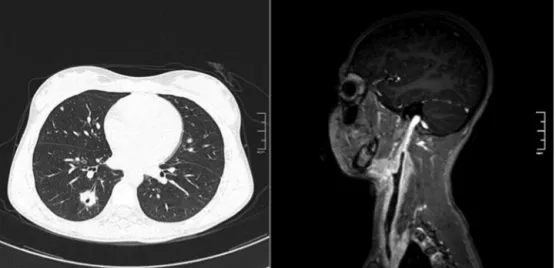 Figure 1 Left, Cross-Sectional Computed Tomography showing pulmonary microabscesses. Right, Post-contrast Sagittal T1- T1-weighted Magnetic Ressonance Angiography, showing the Right Internal Jugular Vein filling failure.