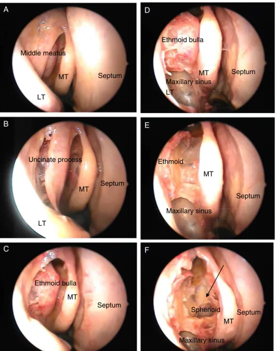 Figure 1 Right nasal cavity (MT, middle turbinate; LT, lower turbinate). (A) The beginning of dissection; (B) uncinate process;