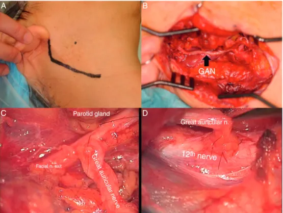 Figure 3 Intraoperative view of side-to-side FHA technique (Patient 11). (A) The modified Blair’s incision is marked in black line.
