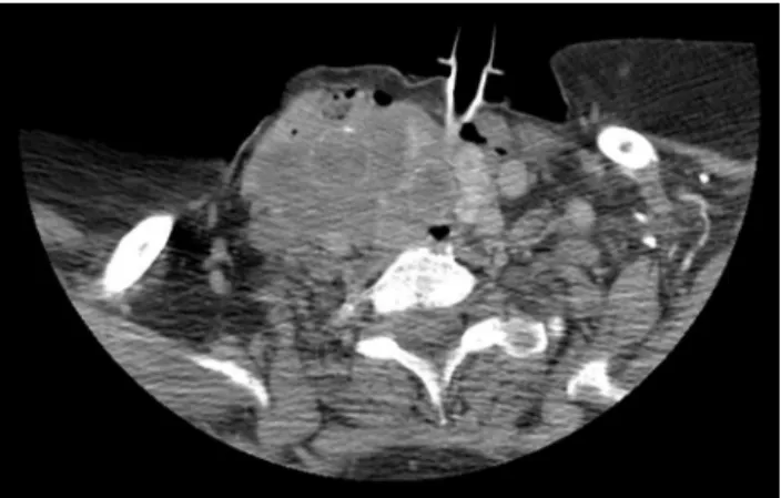Figure 4 CT scan of the second patient, showing an infiltra- infiltra-tive mass in the right thyroid lobe