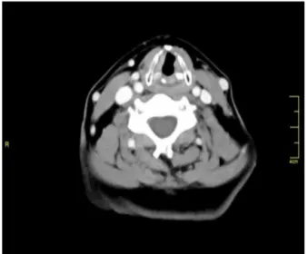 Figure 6 Neck computed tomography six months after treat- treat-ment. Laryngeal edema has decreased a little more over time.