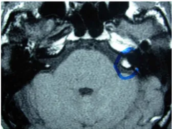 Figure 1 Magnetic resonance imaging shows the lesion (cir- (cir-cled in blue).
