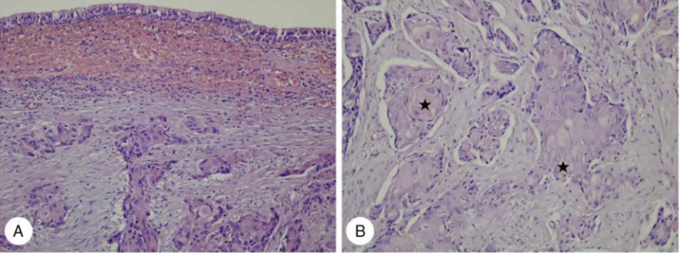 Figure 1 Histopathologic findings of case 1. (A) Infiltrating keratinizing carcinoma of the nasopharynx is noted beneath normal ciliated columnar pseudostratified epithelium (H&amp;E, ×200)