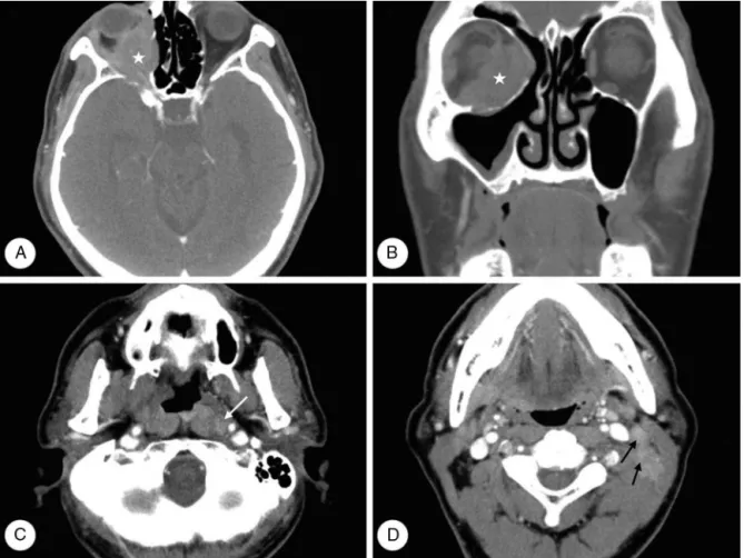 Figure 3 Computed tomography (CT) images of case 2. Axial (A, C, D) and coronal (B) images reveal a soft tissue mass ( ) in the extraconal and intraconal space of the right orbit