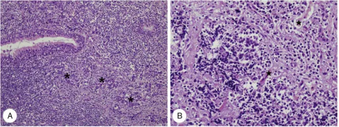 Figure 4 Histopathologic findings of case 2. (A) Infiltrating undifferentiated non-keratinizing carcinoma (*) of the nasopharynx is noted beneath normal ciliated columnar pseudostratified epithelium (H&amp;E, ×200)