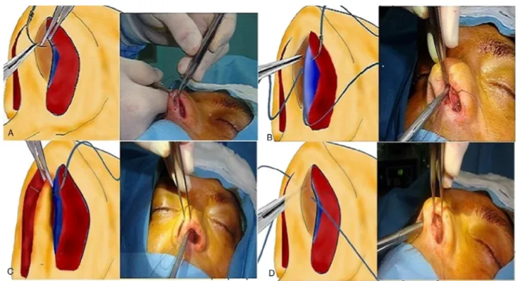 Figure 1 The sequences of the superior septocolumellar suture.