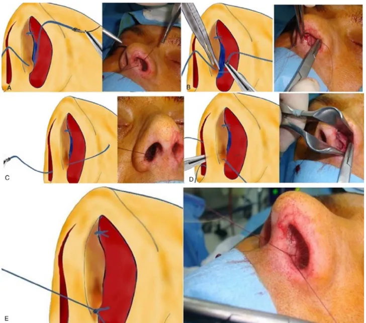 Figure 2 The sequences of the inferior septocolumellar suture.