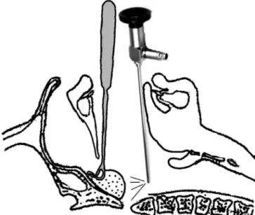 Figure 1 An illustration for the procedure shows the adenoid curette is inserted into the nasopharynx while the 70 ◦ nasal endoscope is introduced behind it.