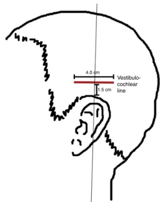 Figure 3 Vestibulocochlear line according to Chinese scalp acupuncture.