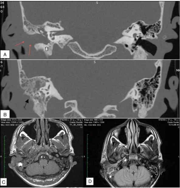 Figure 1 High-resolution coronal computed tomography images of the mastoids (A and B)