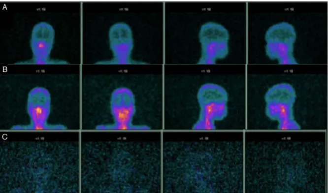Figure 2 99m Tc-mononuclear leukocyte scintigraphy (A---C). Planar scintigraphs from one, three, and 24 h after labeled mono- mono-nuclear leukocyte administration indicate no uptake along the mastoid topography over time.