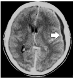 Figure 1 Axial CT scan showing subdural empyema.