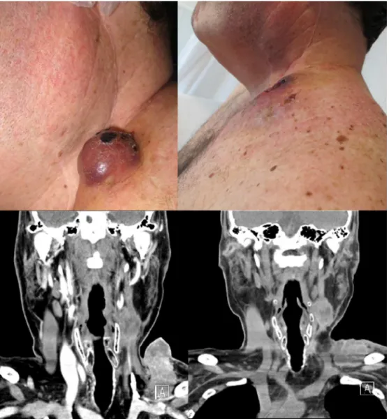 Figure 1 Case 1: External aspect and CT-scan of a lower left cervical mass prior (left images) and after four weeks (right images) of the electrochemotherapy.