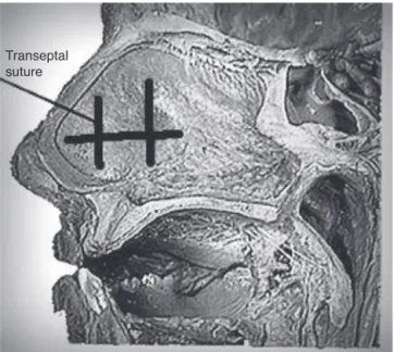 Figure 1 Transeptal nasal suture.