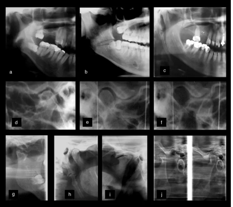 Figure 1 Radiographic assessments of different TMDs. (a---c) Close-up in panoramic image showing mandibular condyle hypoplasia (a), horizontal impaction of the third molar (a, b) fracture line in the region of gonial angle (b) and elongated styloid process
