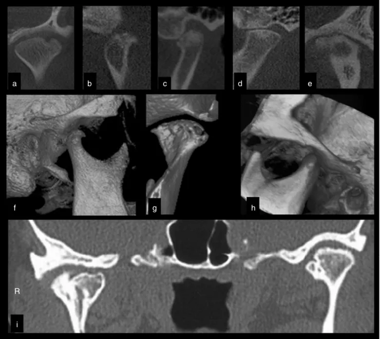 Figure 2 Cone-beam computed tomography (CBCT) assessment of different TMJs in the coronal (a, e) and parasagittal (b---d) views