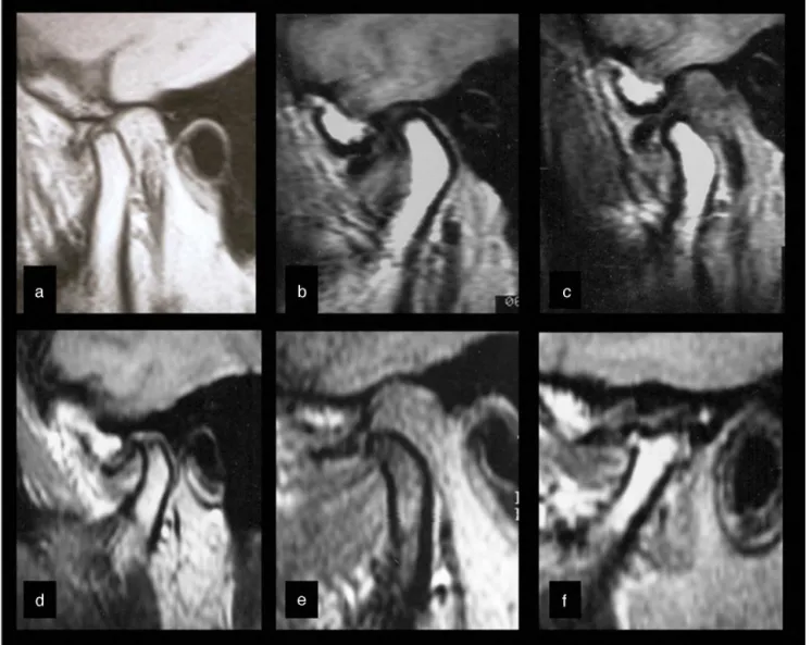 Figure 3 Different MRI assessments disclosing previous joint disc displacement, with no reduction in the parasagittal views