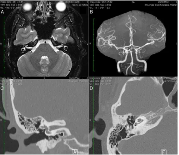 Figure 1 Magnetic resonance (A), magnetic resonance angiography (B) and computerized tomography of temporal bones in coronal (C) and axial slices, without vascular changes that could justify a complaint of pulsatile tinnitus.