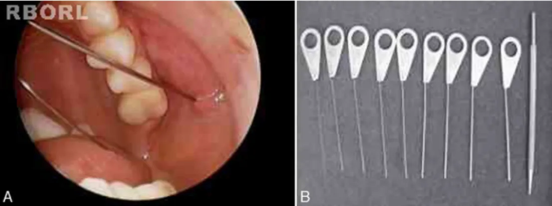 Figure 1 Papilla catheterization of a left parotid gland (A) and probes utilized to perform papilla dilation (B).