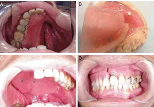 Figure 2 (A) View of defects before definite rehabilitation; (B) image of tissue surface of obturator and magnetic attachment;