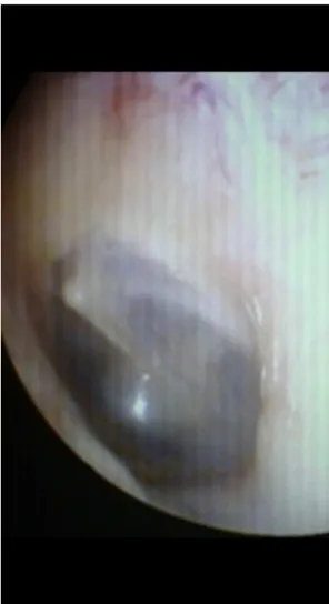 Figure 3 Tympanic membrane after application of bacterial cellulose graft, on microscopic examination.