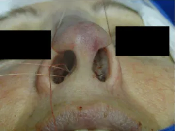 Figure 1 Intercrural medial suture. Step 1 --- passage with a 5 mm curved needle above the base of columellar pocket to the external aspect.