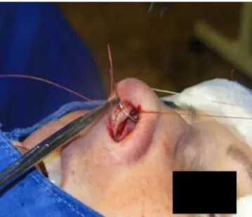 Figure 10 Nasal tip rotation suture. Step 4 --- the needle is trespassed 5 mm behind and below the nasoseptal angle.