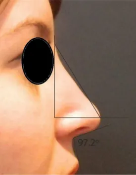Figure 14 Postoperative. Nasal measures in late postopera- postopera-tive period.