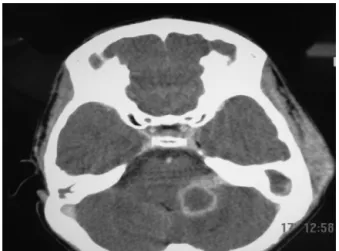 Figure 1 Temporal bones CT, axial view. The arrow shows ero- ero-sion of the lateral semicircular canal on the left, in a patient with CCOM
