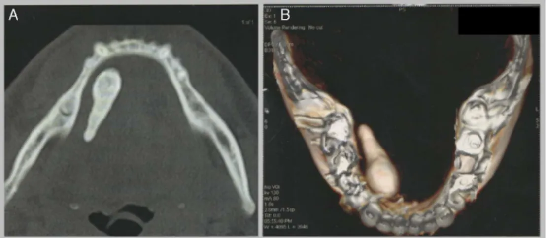 Figure 1 (A) Computed tomography scan (axial aspect) revealing a mineralized tissue with heterogeneous density and dimensions of 3.0 × 1.0 cm, approximately