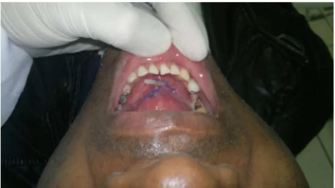 Figure 4 The catheter and the sutures are in the correct surgical placement.