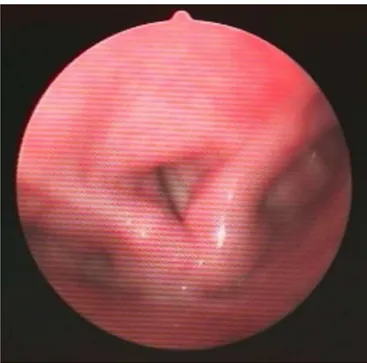 Figure 1 The endoscopy executed during sleep evidences the paradoxical movement of adduction during inspiration.