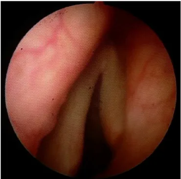 Figure 3 The control endoscopy executed at two months from surgery shows the good increase of the glottic respiratory space.