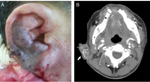 Figure 1 Gross findings and temporal bone computed tomographic angiography findings on the ear of a 60 year-old man, as recorded in the emergency room: (A) the patient presented with a swollen ear and spontaneous massive bleeding; (B) temporal bone compute