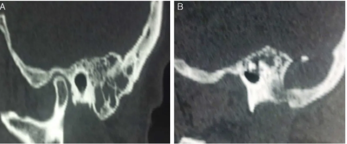 Figure 1 (A) Temporal bone CT scan: thickened mucosa within the mastoid air cells. (B) Presence of an expansive osteolytic temporal bone lesion; note the destruction of mastoid apex.