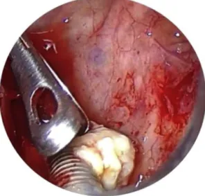 Figura 3 Visualizac ¸ão de implante dentário por trocarte com endoscópio de 0 ◦ .