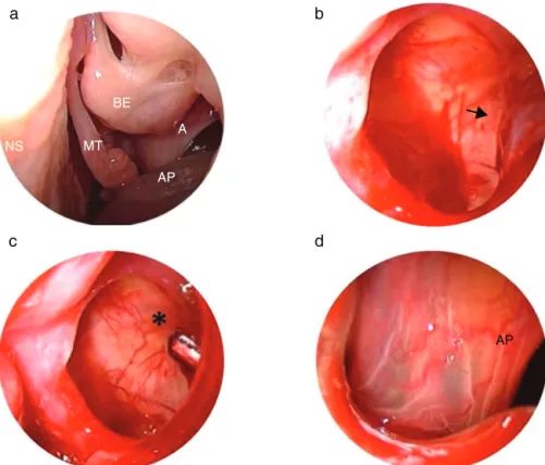 Figure 1 (a) Antrochoanal polyp emerging from the middle antrostomy of the left maxillary sinus is noted on the endoscopic examination