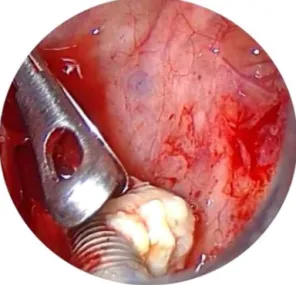 Figure 3 Dental implant view by trocar using 0 ◦ endoscope.