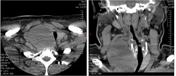 Figure 2 CT-scan of the thyroid mass. Due to the patient’s chronic kidney failure, intravenous contrast could not be used