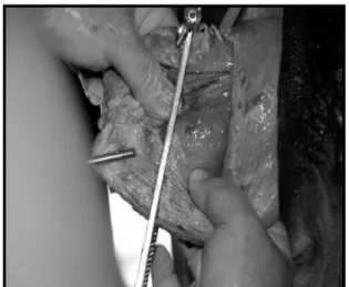 Figura 2 - Posicionamento da pinça de conchectomia em mucosa  vaginal prolapsada de vaca