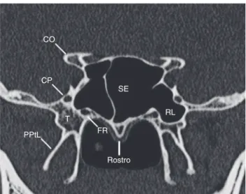 Figura 1 O corte coronal em que tanto o canal pterigoi- pterigoi-deo como o forame redondo são visualizados (em geral no ponto médio do seio esfenoide)