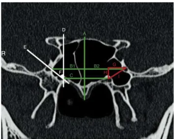 Figure 2 Measurement indexes of the study. A, Imaginary midline vertical to the rostrum; B (1), distance between right FR to midline; B (2), distance between left FR to midline; C,  imag-inary horizontal line connecting the VCs; D, imaginary vertical line 