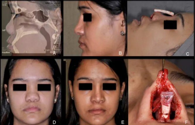 Figura 1 (A) Perfil pré-operatório e TC sagital. (B) Vista do perfil pós-operatório. (C) Intraoperatório: cartilagem costal para enxerto onlay dorsal
