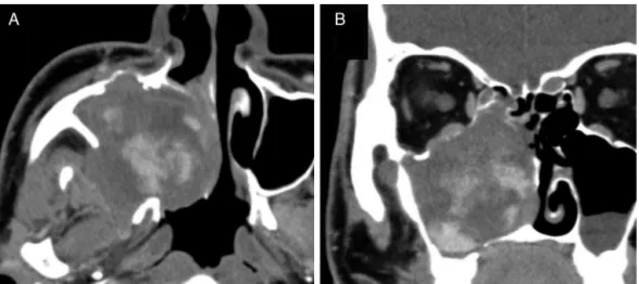 Figure 1 Enhanced CT in Case 1. Axial (A) and coronal (B) images. A strong, spreading, and gradually increasing contrast effect is seen during the arterial phase.