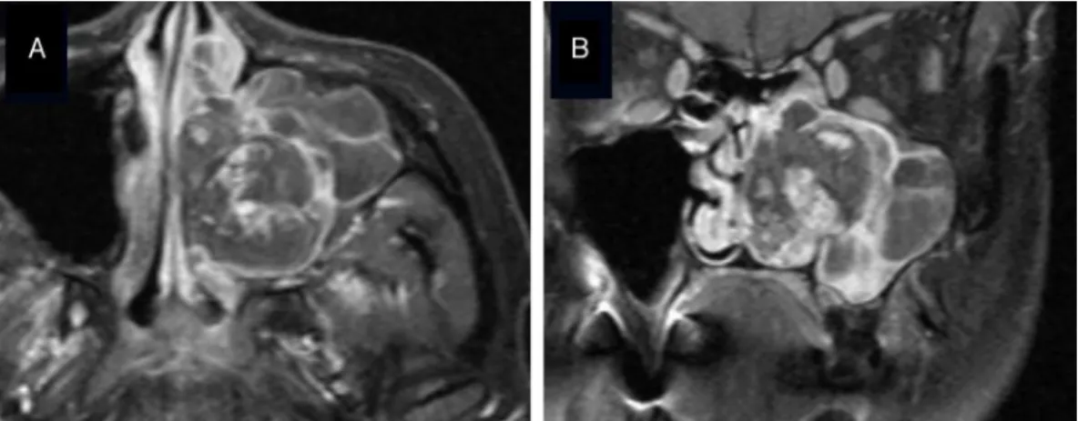 Figure 3 Gadolinium-enhanced MRI of Case 2. Axial (A) and coronal (B) images. A heterogeneously enhanced vascular tumor was suspected.