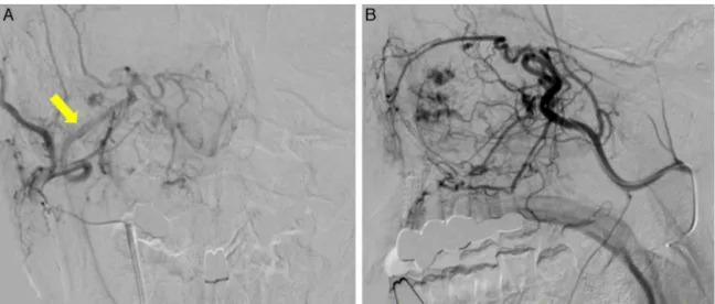 Figure 4 External carotid arteriography of Case 3. Frontal (A) and profile (B) views, showing tumor staining in the area corre- corre-sponding to the entire right maxillary sinus