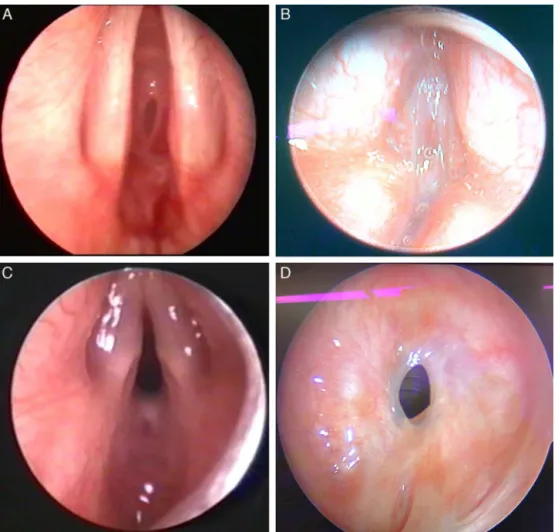 Figure 1 Mapping of various pathologies. (A) Grade 3 isolated subglottic stenosis; (B) type 4 glottic web; (C) type 4 posterior glottic stenosis; (D) cervical, moderate, 1---3 cm isolated tracheal stenosis.