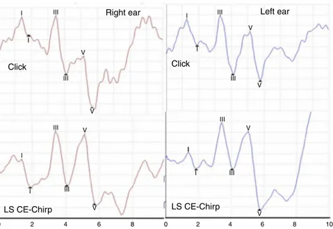 Figure 1 Example of ABR recording with Click and LS CE-Chirp ® stimuli in one subject